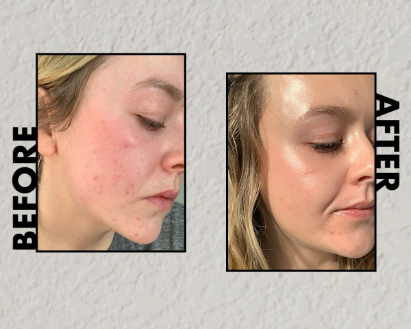 woman's azelaic acid before and after photo 
